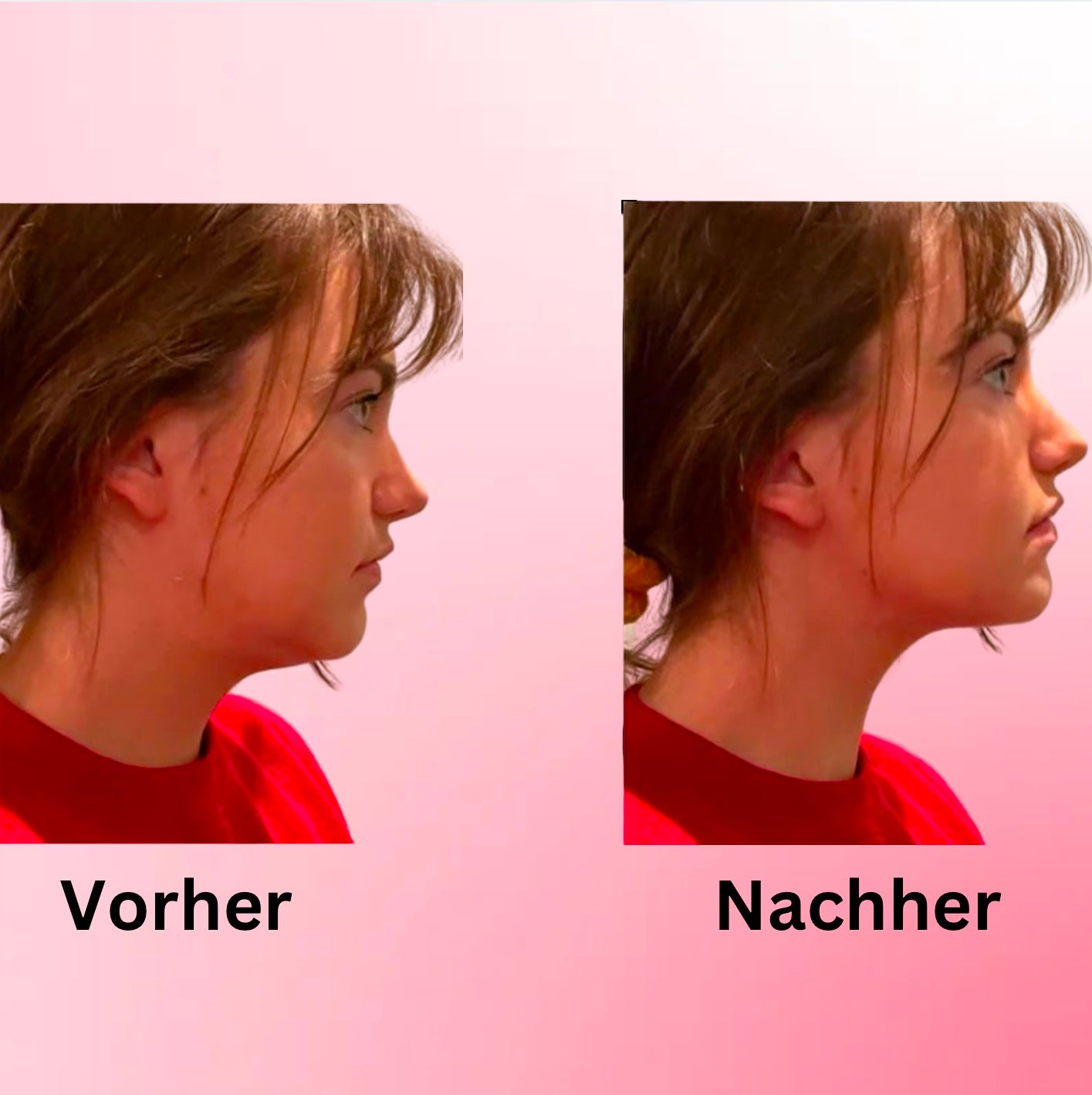 ChinRemover- Maske zur Gewichtsabnahme und zurückbildung des Doppelkinn