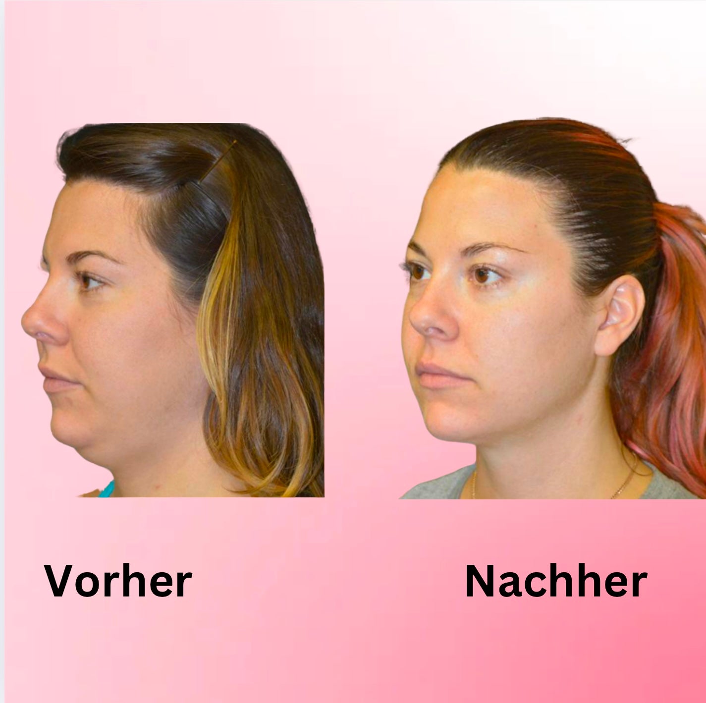 ChinRemover- Maske zur Gewichtsabnahme und zurückbildung des Doppelkinn