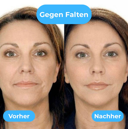 GlowNeedle Pro - Dein Mikroneedling für zuhause!