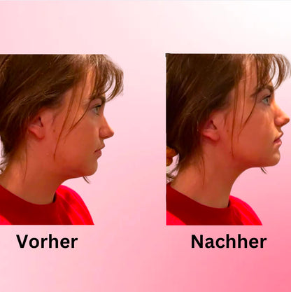 ChinRemover- Maske zur Gewichtsabnahme und zurückbildung des Doppelkinn
