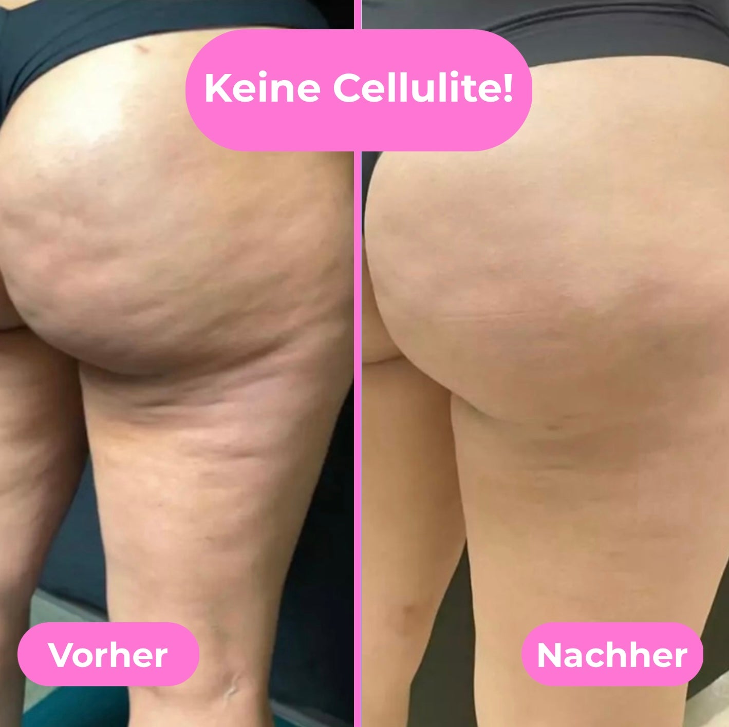 CelluRoller Pro - Die einfache Massage gegen Cellulite