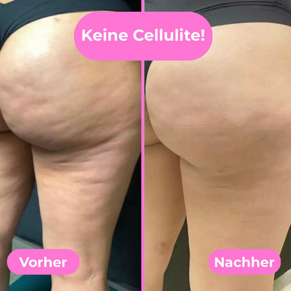 CelluRoller Pro - Die einfache Massage gegen Cellulite