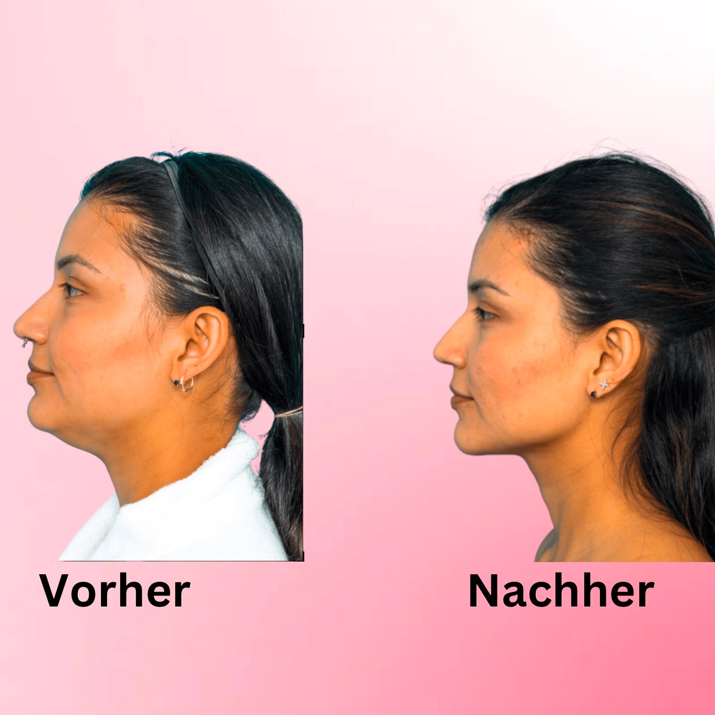 ChinRemover- Maske zur Gewichtsabnahme und zurückbildung des Doppelkinn