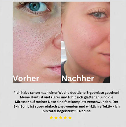 SkinSonic 360 - Gesichtspeeling mit integrierter Massagefunktion!