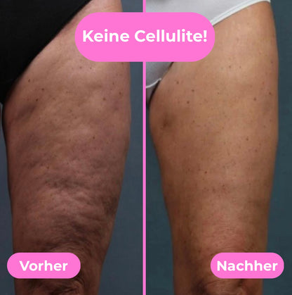 CelluRoller Pro - Die einfache Massage gegen Cellulite