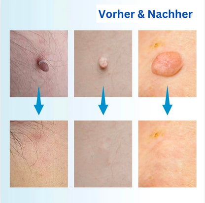WartFree - Dein perfektes Set um deine Warzen Zuhause zu behandeln